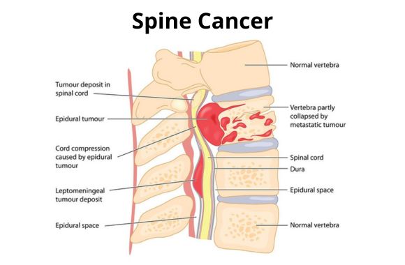 Dr. Sheetal Mohite - best spine surgeon in Mumbai