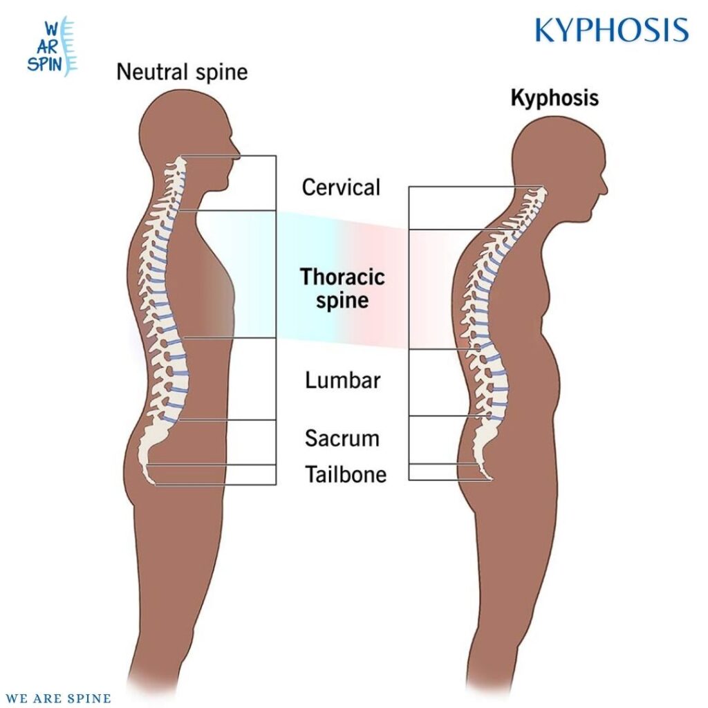 Kyphosis Treatment in Mumbai