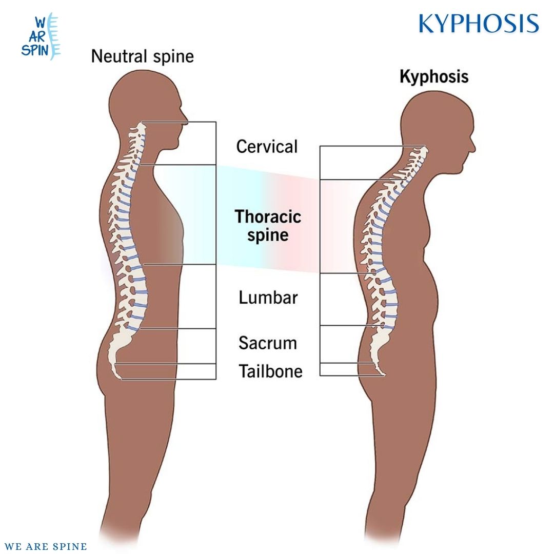 KYPHOSIS