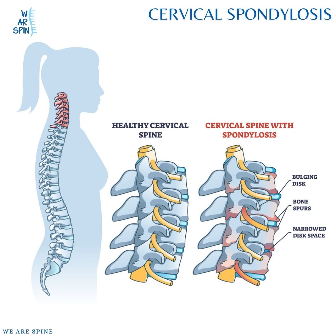 CERVICAL SPONDYLOSIS