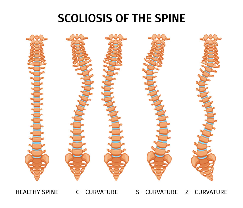 Graph illustrating the average cost of scoliosis surgery in India