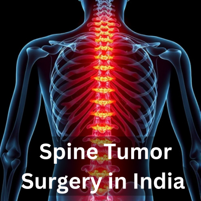 Spine tumor surgery in India using advanced medical technology