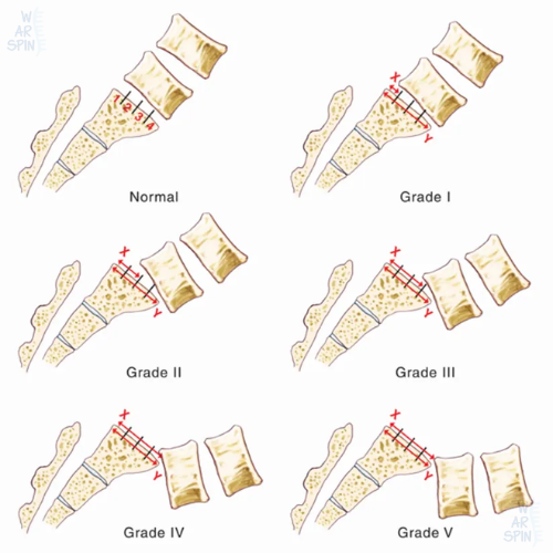 Diagram showing the six types of spondylolisthesis with explanations of causes and symptoms.