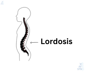 Illustration of excessive inward curvature of the lower back in lordosis condition.