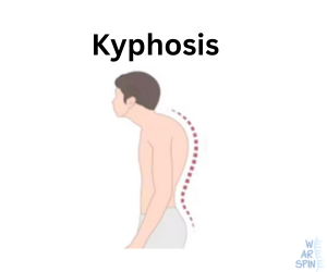 Side view of a person with kyphosis, highlighting the rounded upper back or hunchback appearance.