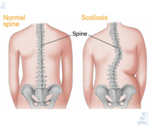 X-ray image of a spine with scoliosis showing an abnormal sideways curvature.