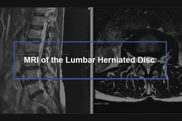 mri slipped disc