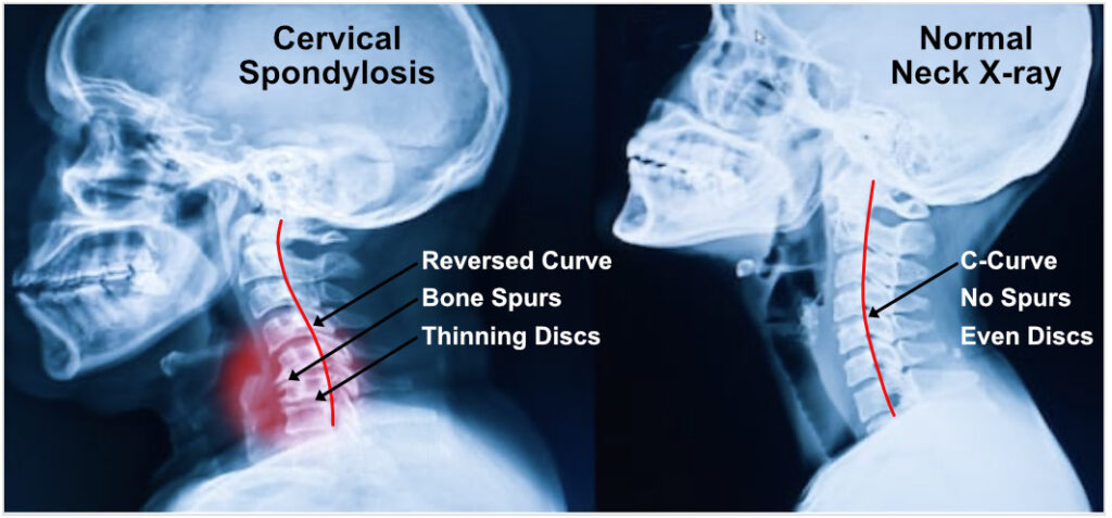 Cervical Spondylosis 1024x477 1