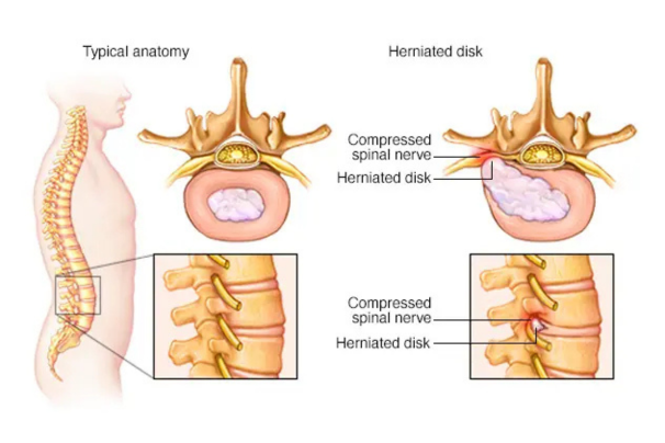 herniated disc