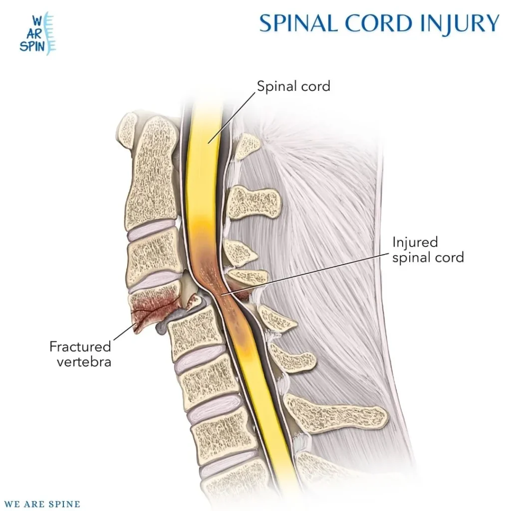 Spinal Cord Injury Treatment in Mumbai