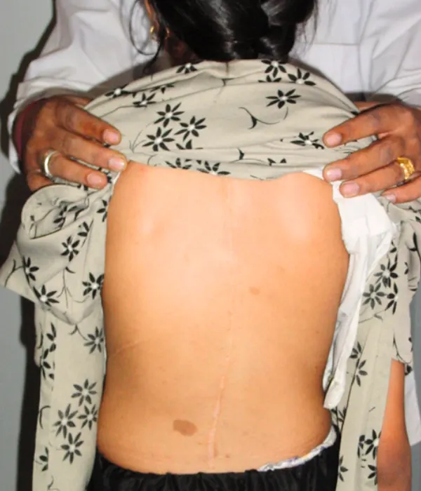 After Scoliosis Surgery