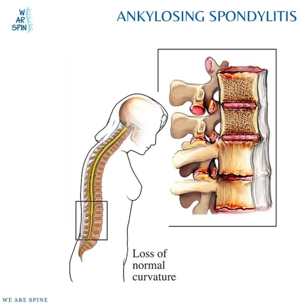 Ankylosing Spondylitis treatment in Mumbai