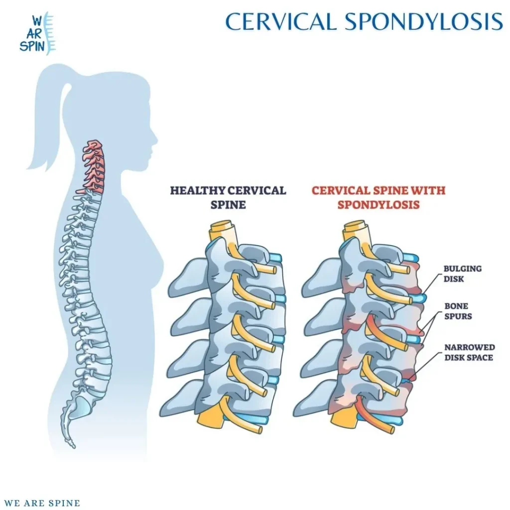 Cervical Spondylosis Treatment in Mumbai