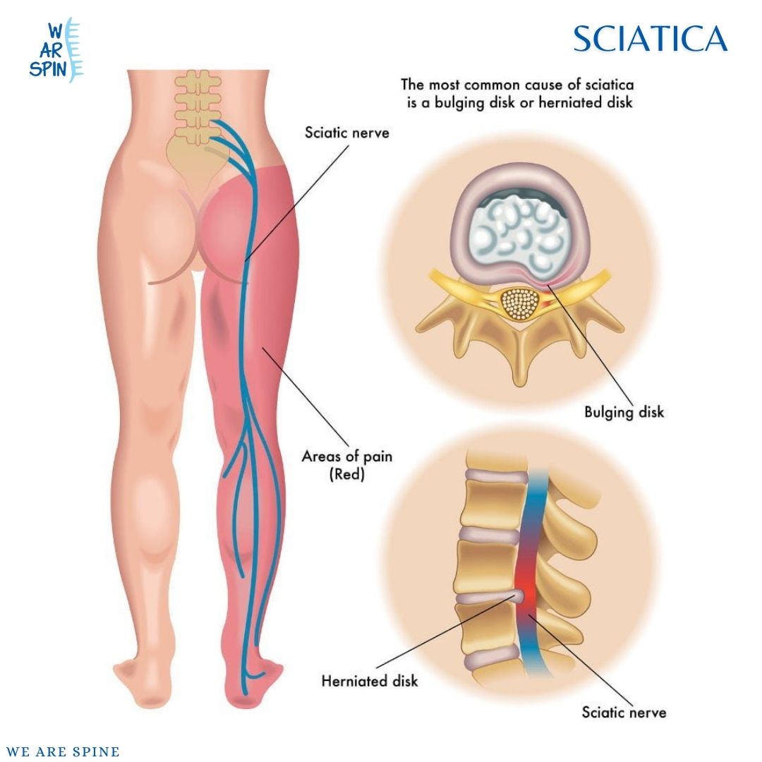 Sciatica Treatment in mumbai