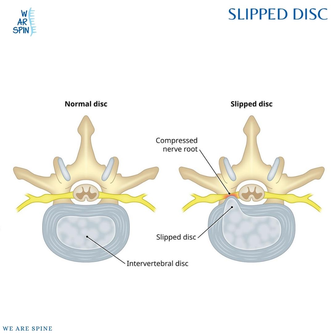 Slipped Disc Treatment in Mumbai