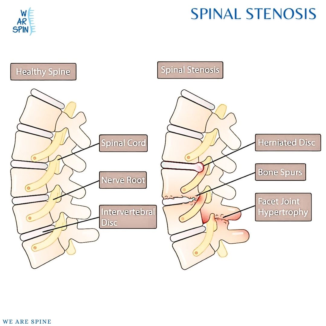 Spinal Stenosis Treatment in mumbai