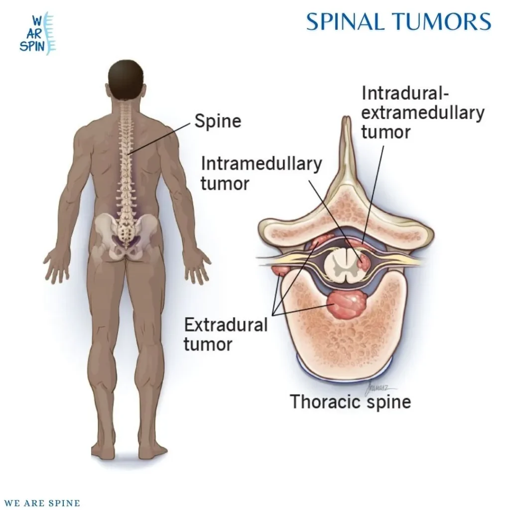 Spinal Tumor Treatment In Mumbai
